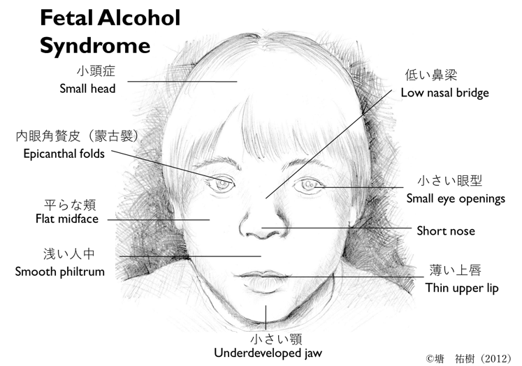 うつ病 顔つき